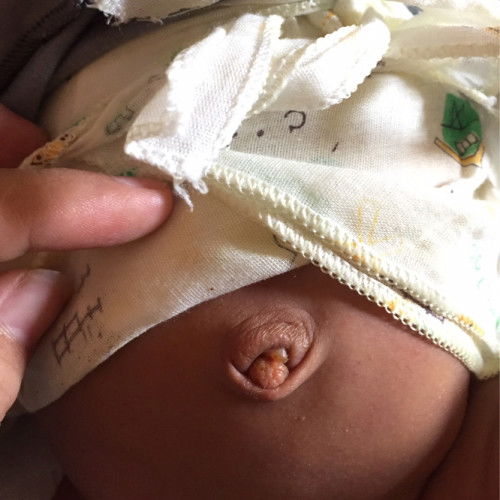 Pusar bayi ada granuloma