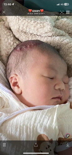 ลักษณะรอยแผลจากที่เครื่องดูดทารกออก เป็นอย่างไร  ?