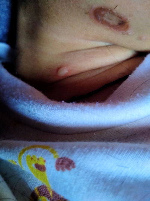 bisul pada bayi 9 bulan