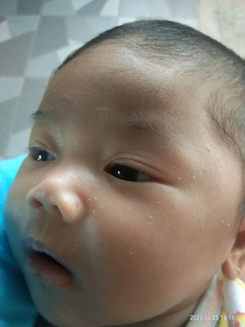 Bintik putih di muka bayi