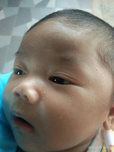 Bintik putih di muka bayi