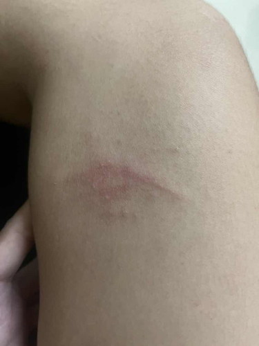 มีแม่ๆท่านไหนเคยเป็นผื่นตอนท้องบ้างมั้ยคะ