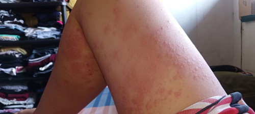 Rashes? Pls see pic.