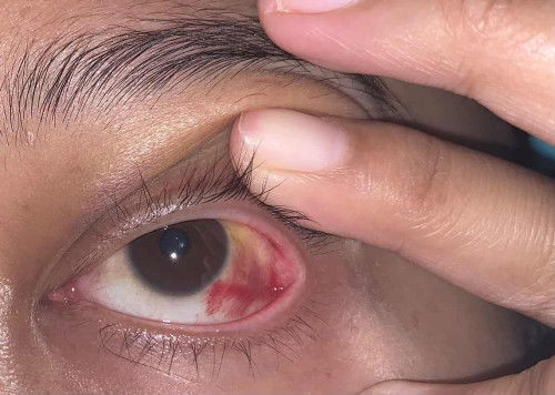 Subconjuctiva bleeding di mata