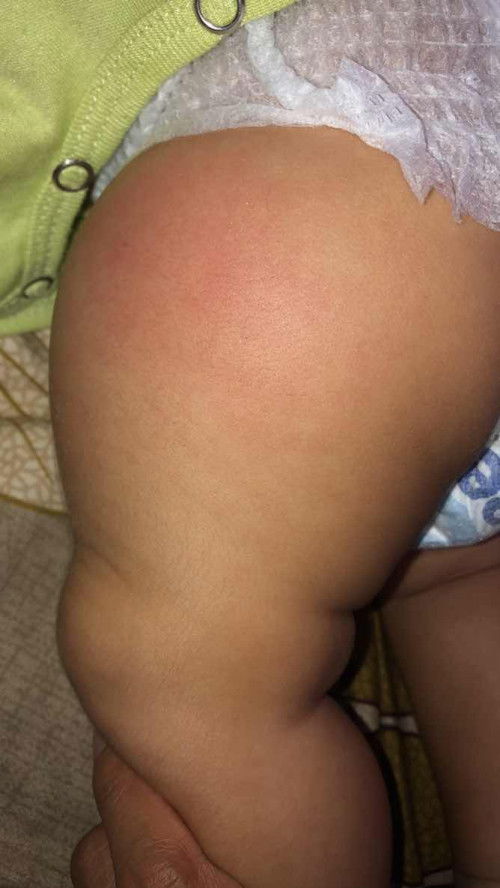 Merah bengkak di paha setelah imunisasi DPT 2