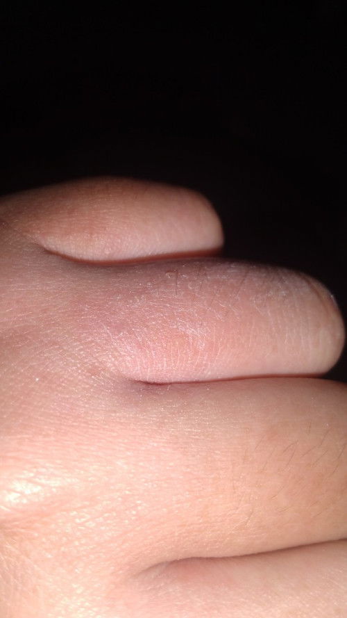 Pangangati ng katawan sa 3rd trimester