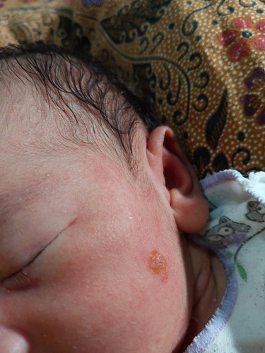 Bun, ada yang pernah ngalamin newborn kena saraf gak kulitnya? Share cara penyembuhannya dong bun🥲