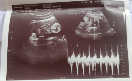 #girlorboy?
Mga mii confused talaga ako if confirm na baby girl po. 🥹