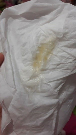 Keputihan saat hamil 11W