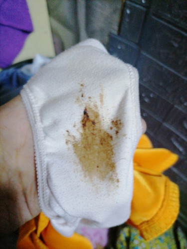 Mga mii msama po ba mag ka discharge na kulay brown ?