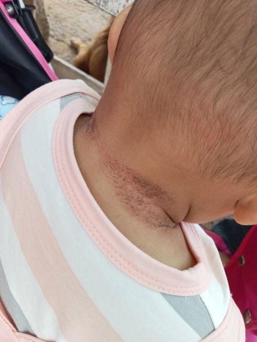 คอตกสะเก็ด