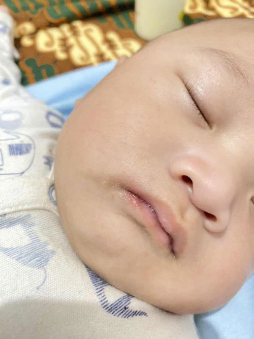Bibir pinggir bayi merah pecah pecah gitu