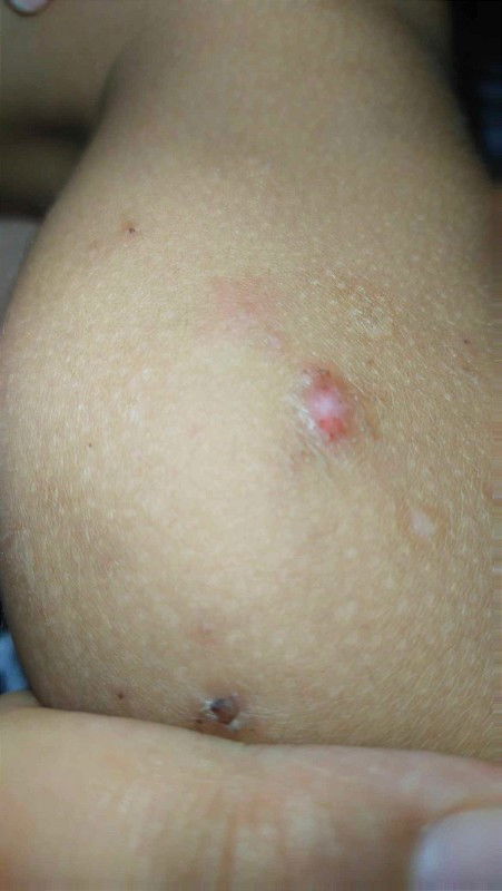 Kagat o kalmot ng aso ?