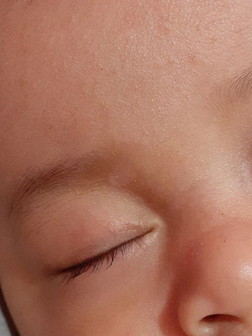 Bercak putih di bawah alis bayi