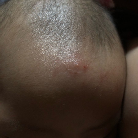 Mosquito bite