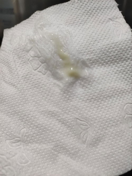 Vaginal Discharge, Normal Ba?