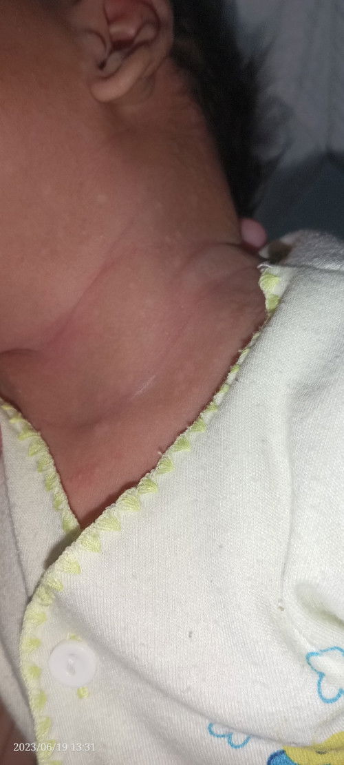 Timbul bekas putih macam panau pada kulit bayi