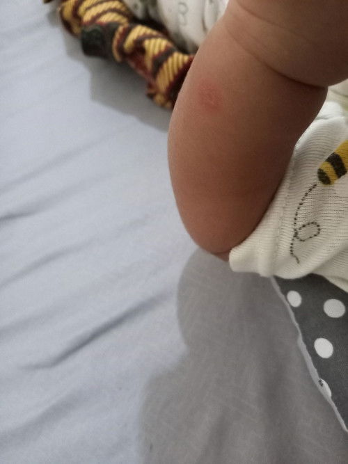 Halo bun, mau nanya kira2 ada yang anaknya pernah mengalami luka di tangan seperti ini ngga ya?