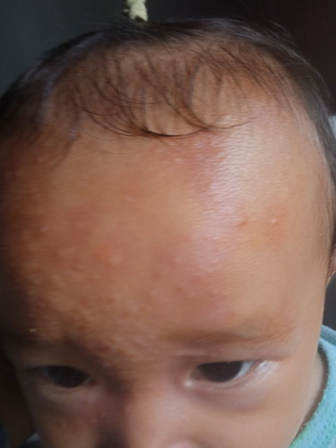 น้องมีผื่นขึ้น