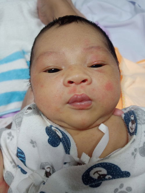 ผดผื่นที่หน้า