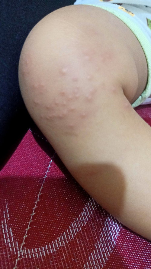 Gatal dan bintik bintik di dengkul