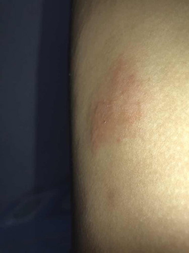 ลักษณะของงูสวัด?