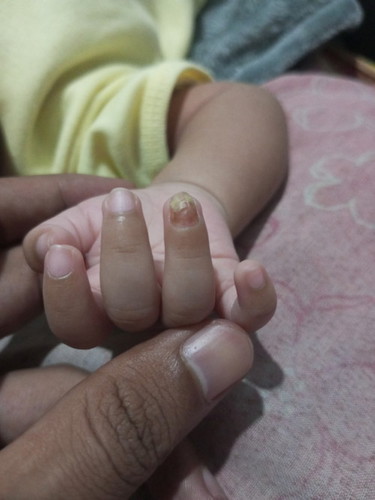 Kuku di jari manis sebelah kanan dan kiri
