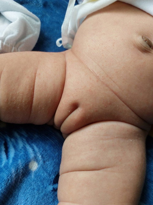 Diaper Rash
