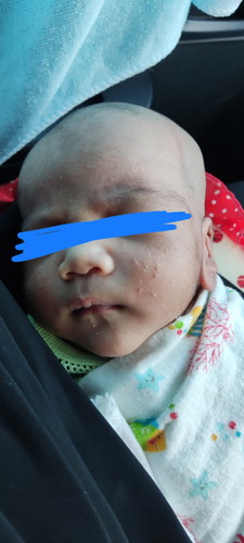 Ruam di muka dan kepala