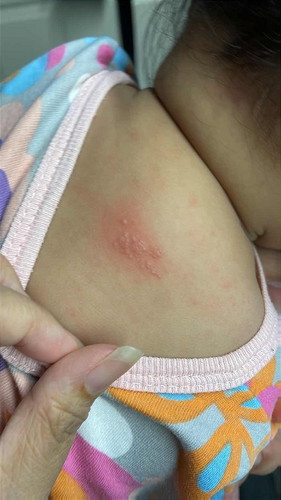 Desperate mum need advise on baby’s rash?