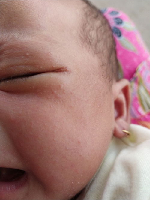 Bund, obat biang keringat apa ya untuk NB 1 bulan