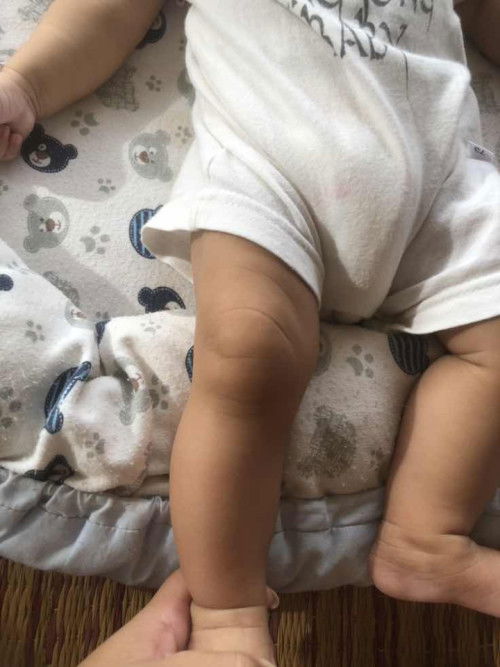 ขาน้องจะโคงมั๊ยค่ะ คนแก่ที่บ้านบอกจะโคงบอกให้ดัด แม่ก็ศึกษามาว่าไม่ควรดัด ตอนนี้เคลียดแล้วค่ะ