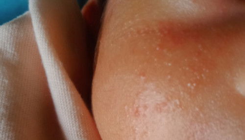 Bun mau tanya ini merah kenapa ya bun? Cara obatin nya pke apa?