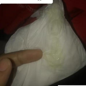 Cara membedakan keputihan dan rembesan air ketuban