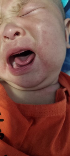 Baby rash on mouth