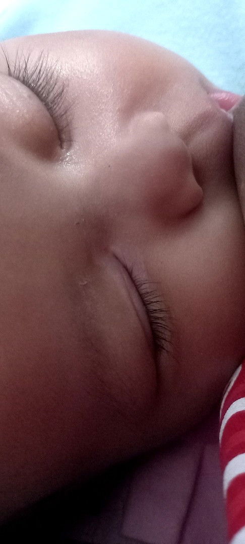 Ada yang kelopak mata bayinya terjekena bercak putih di kelopak mata seperti jamur di obatin apa ya?