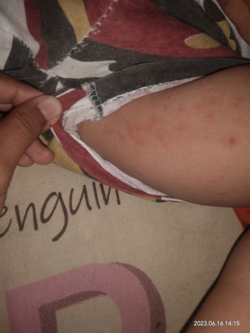 Bintik merah pada anak