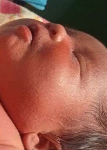 Bun ? Anak sya keluar bintik" putih banyak di muka & badan , cara ngilanginnya pakai apa ya ?