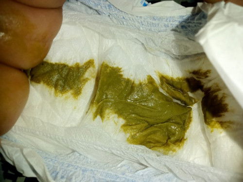 Mga mii normal ba ganyan poop ni baby? Medyo runny, sorry sa picture.