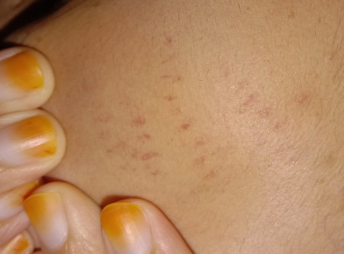 STRETCH MARK