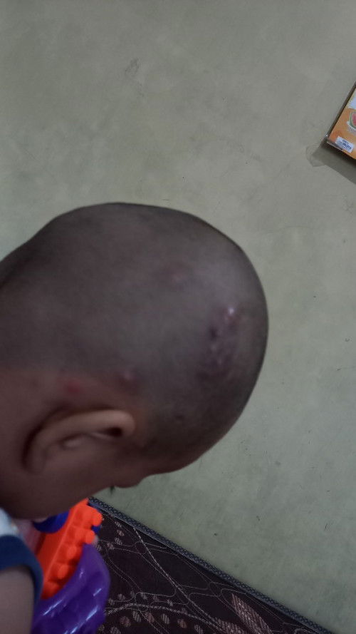 Kepala anak beruntusan seperti bisul ( Hanya bagian kepala saja )