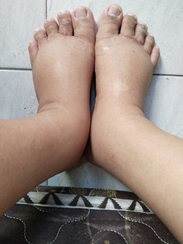 Mau tanya bun hamil 32minggu kaki dan tangan bengkak apakah normal