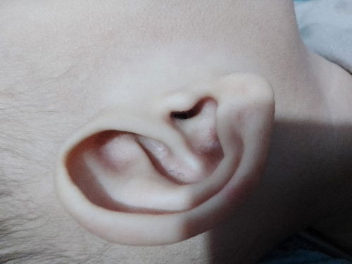 Keluar cairan ditelinga Karena demam tinggi. Tapi tidak berbau, apa penyebab nya y Bu