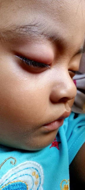 Benjolan merah di kelopak mata atas