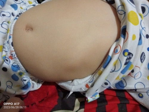 Tulang rusuk menonjol