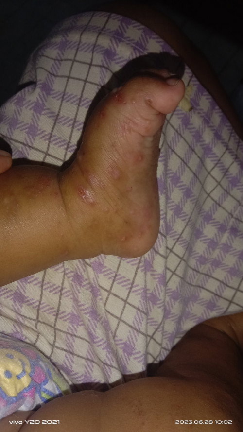 kaki kena cacar air