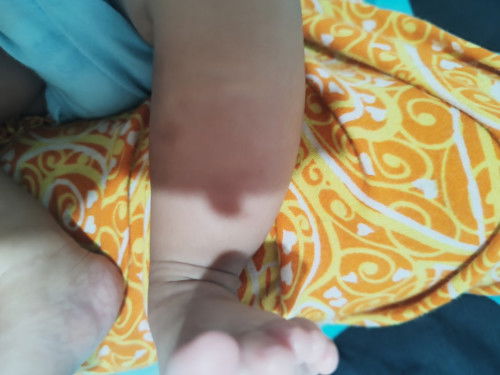 Cara menghilang kan bekas gigitan nyamuk