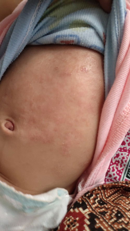 Bayi 2 bln lebih, Kulit merah beruntusan seperti luka sudah 2-3minggu