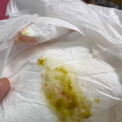 Baby 3 bulan cirit birit