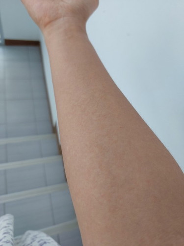 แม่ๆคนไหนเป็นผื่น แดง คันระหว่างตั้งครรภ์บ้างไหมคะ